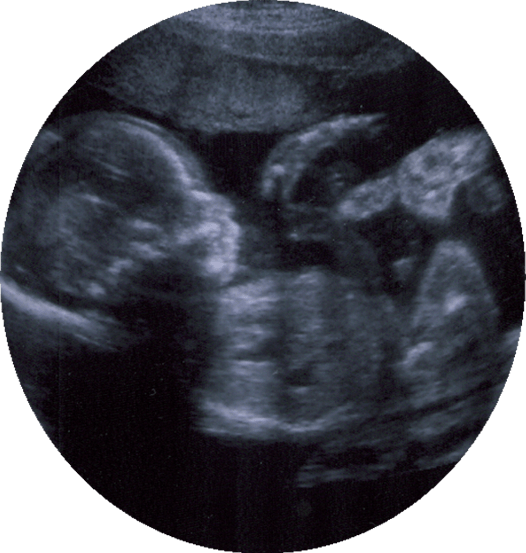 Ultrasound